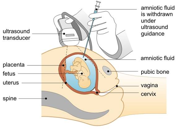 amniocentesis diagram