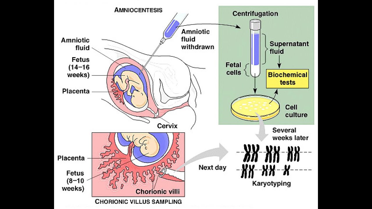 Amniocentesis Diagram