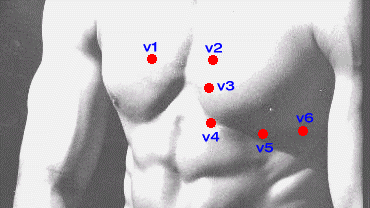 ecg electrode placement diagram