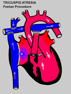 glenn shunt diagram