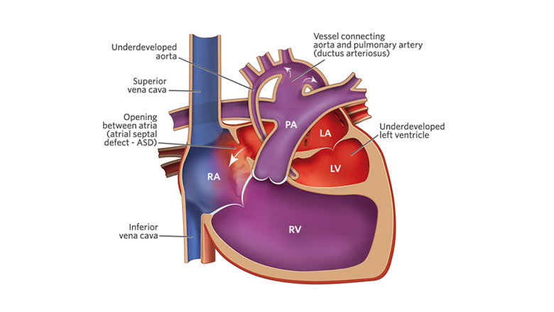 glenn shunt diagram