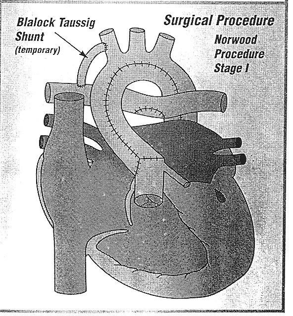 glenn shunt diagram