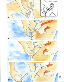 insert tampon diagram