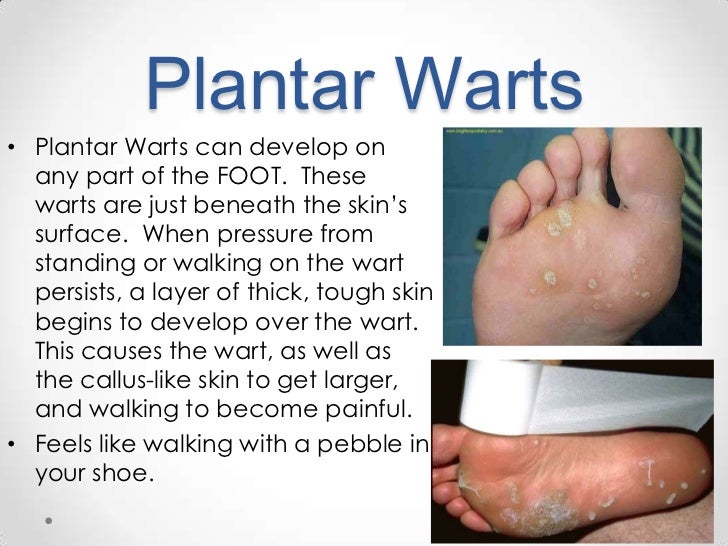Planters Wart Diagram