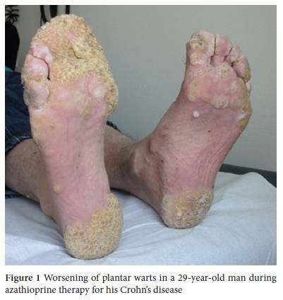 planters wart diagram