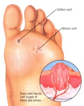 planters wart diagram
