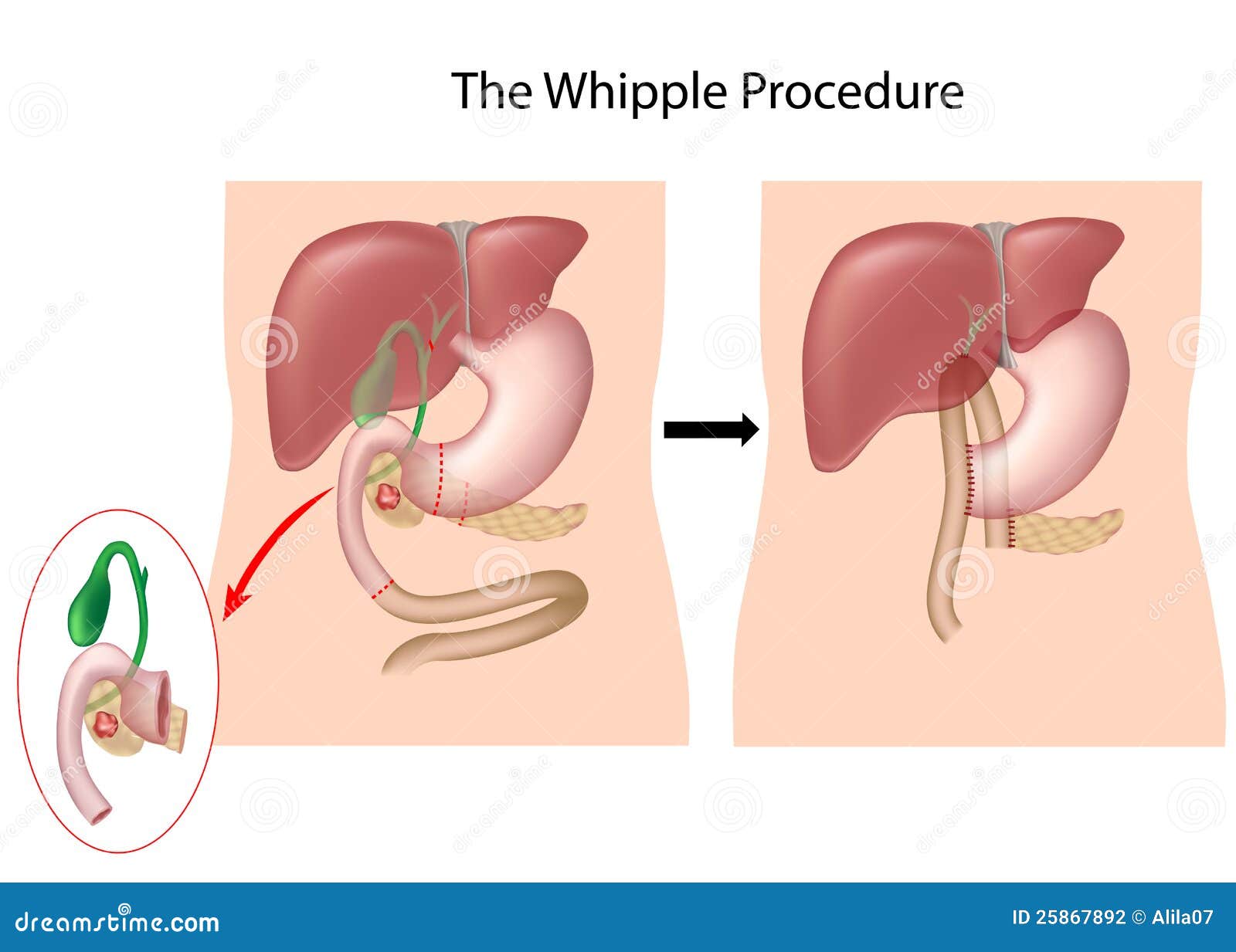 Whipple Procedure Diagram