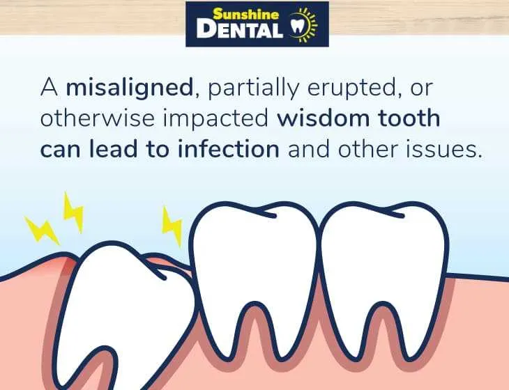 impacted wisdom teeth diagram