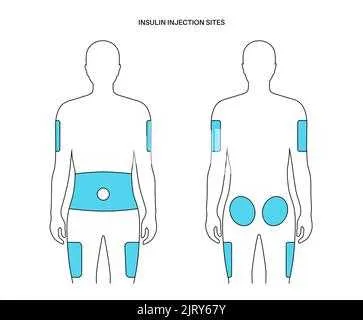insulin injection sites diagram printable