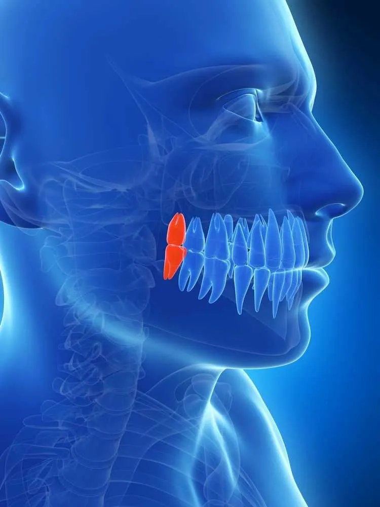impacted wisdom teeth diagram